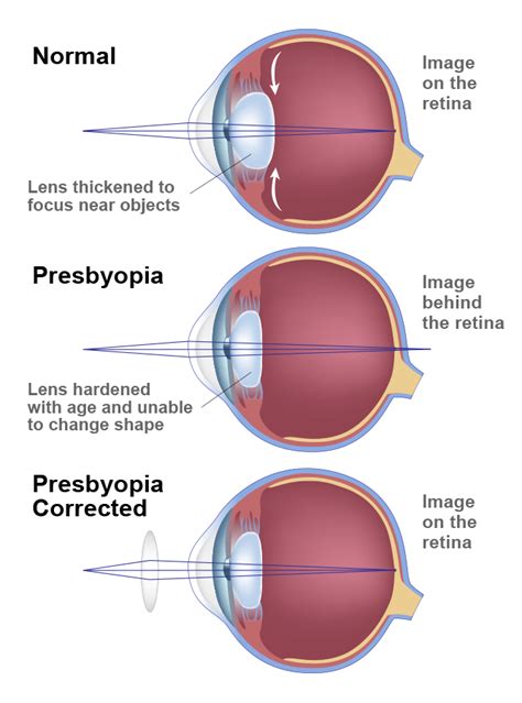 what is presbyopia